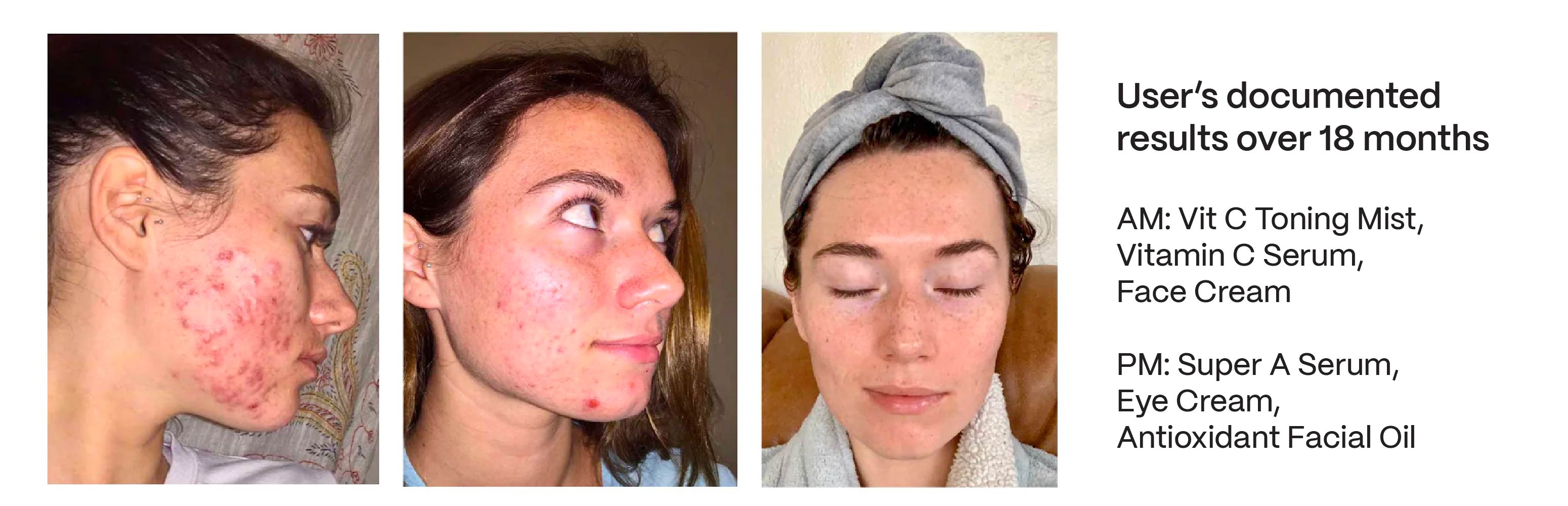Acne before and after 