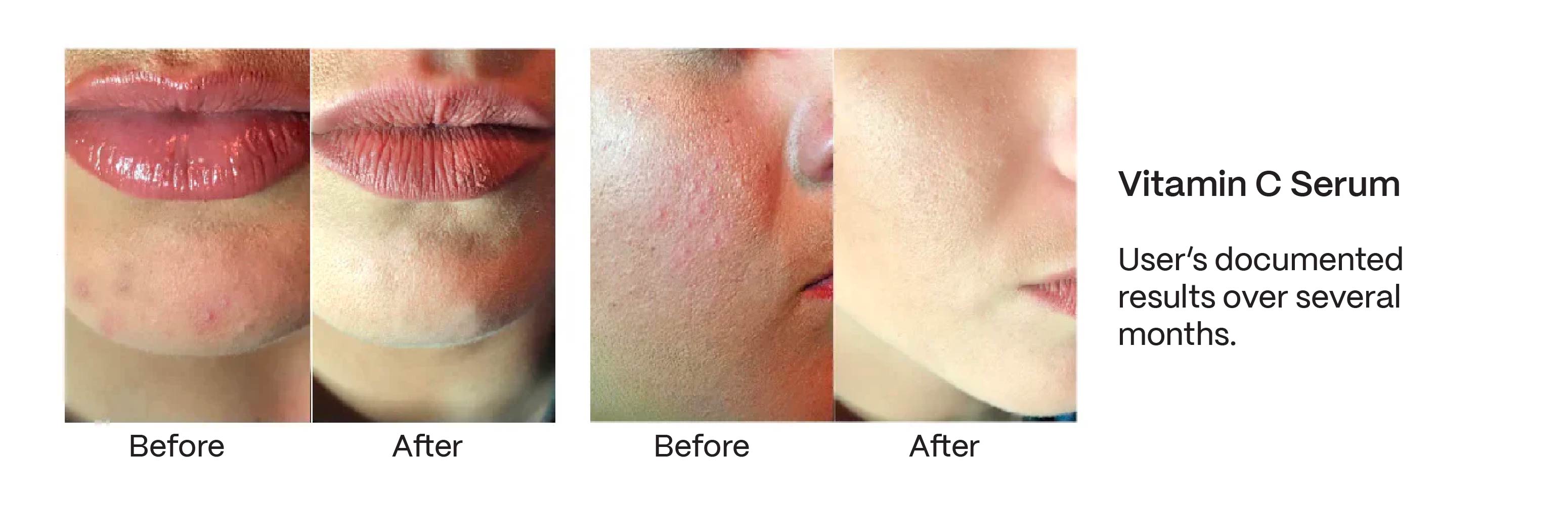 Vitamin C Serum before and after 