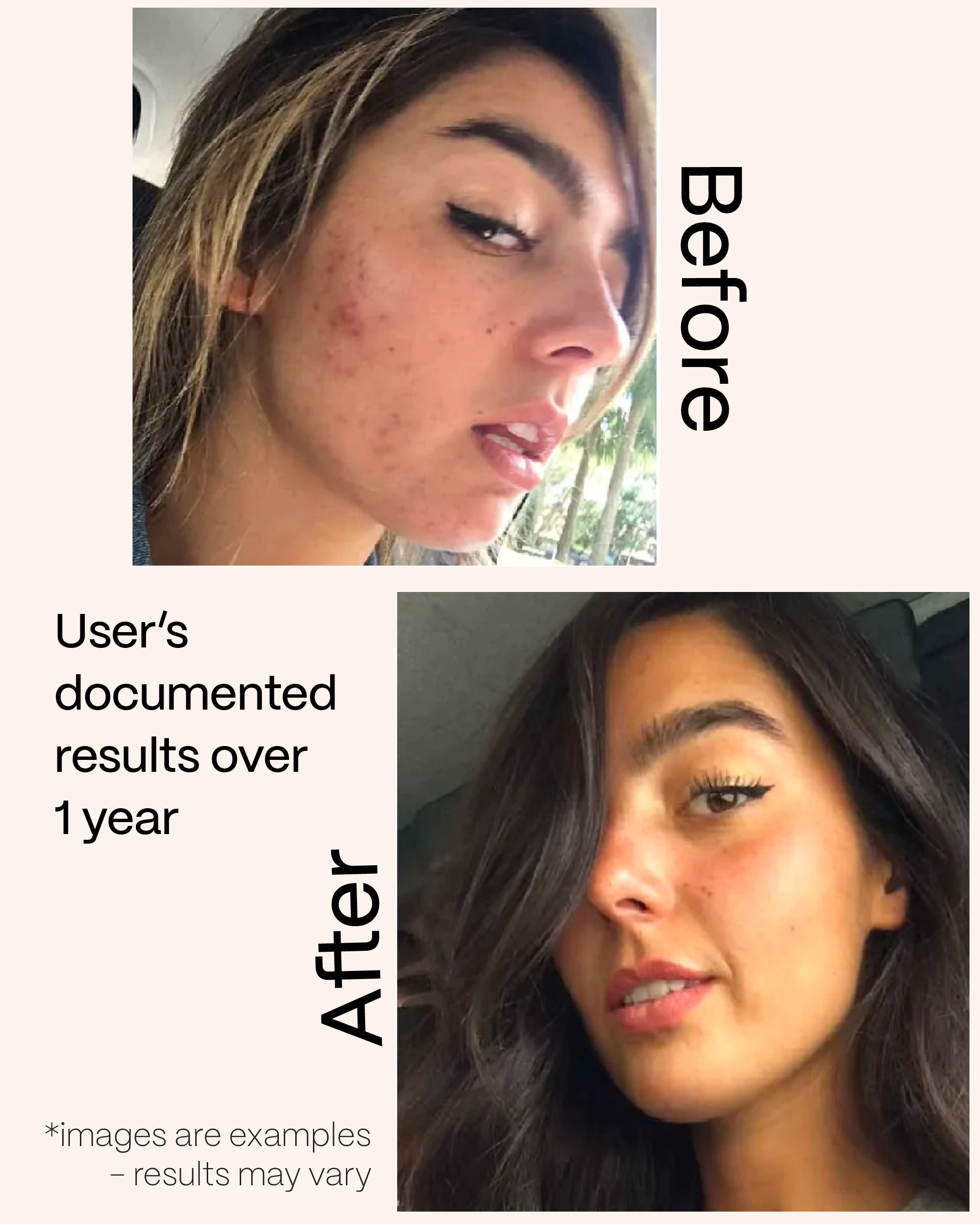 Acne results before and after images