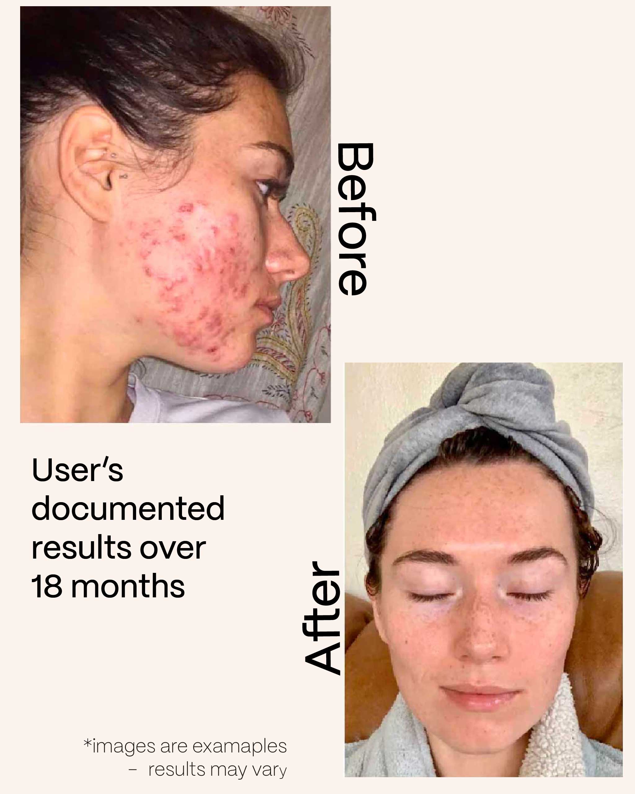 Acne before and after images
